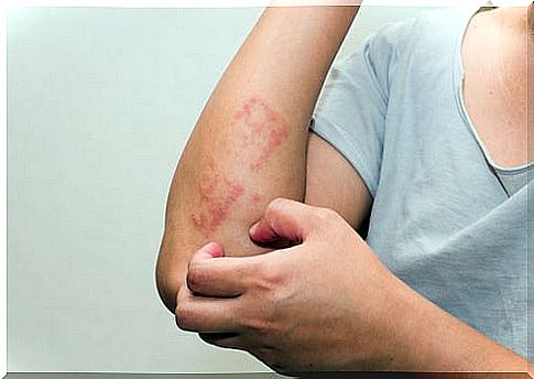 What is psoriasis and why does it occur