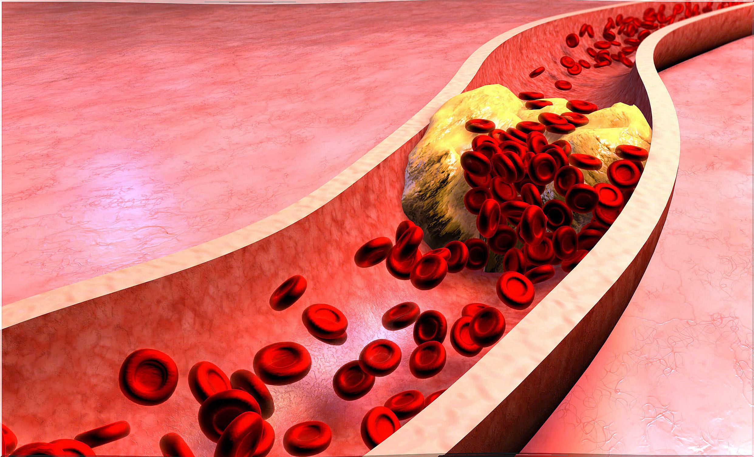 Atheroma plaque that is detected with arteriography.