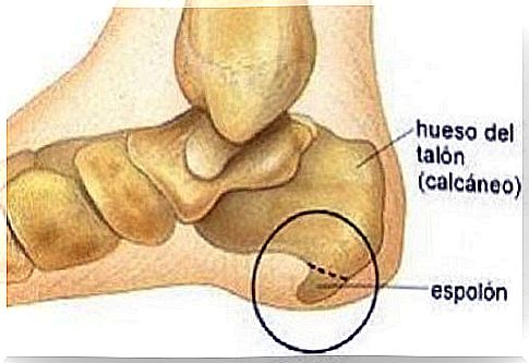 Calcaneal spur