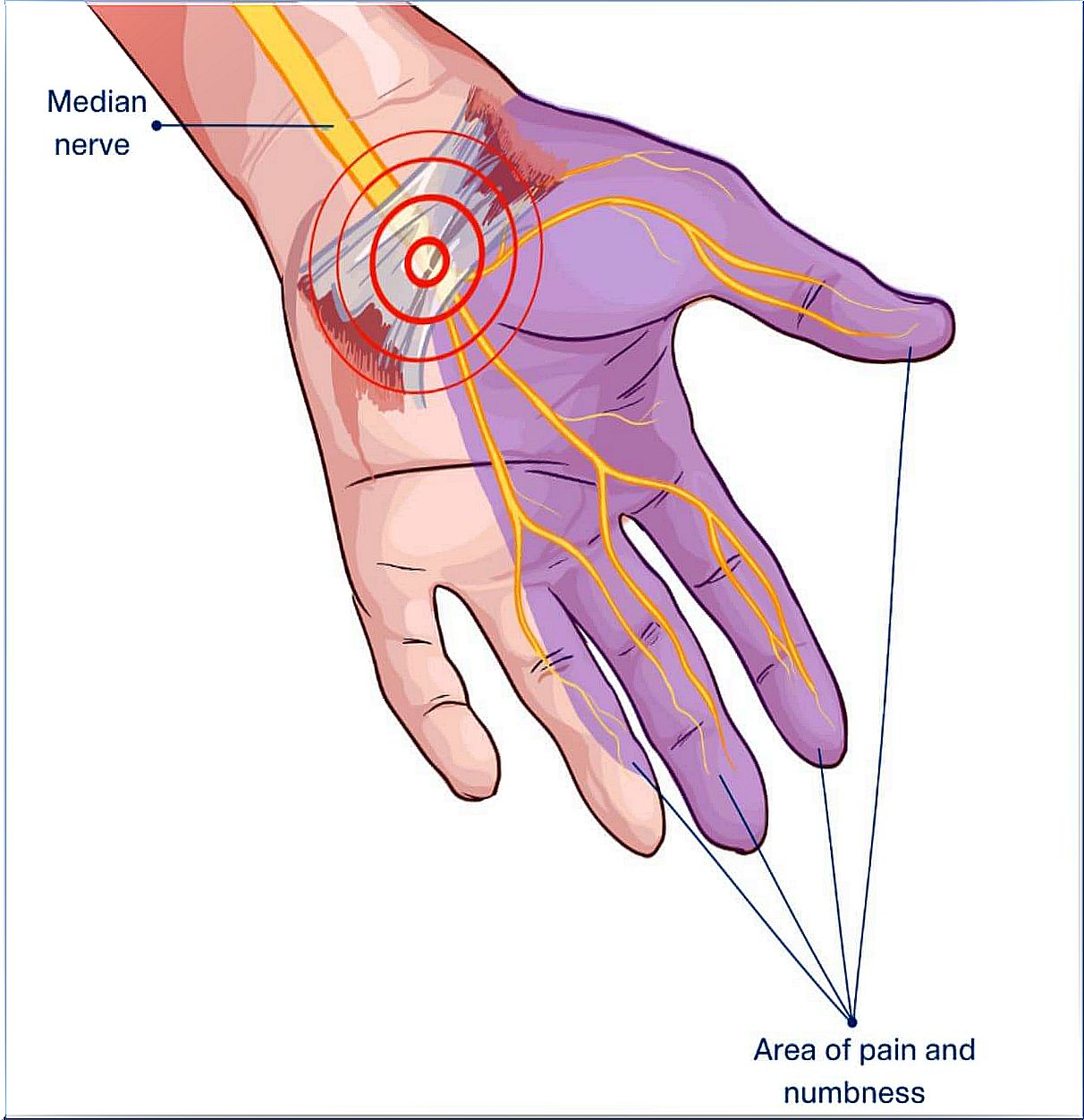 The symptoms of carpal tunnel syndrome are located in the lower arm mainly.