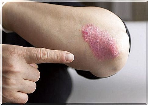 psoriasis on the elbow