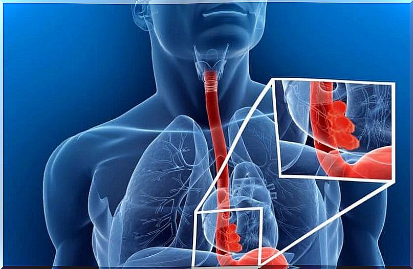 Representation of a tumor in the esophagus