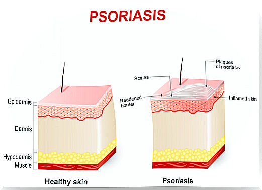 Factors that affect your psoriasis