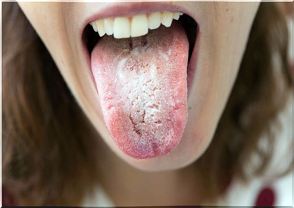 White tongue is one of the symptoms of oral yeast infection.