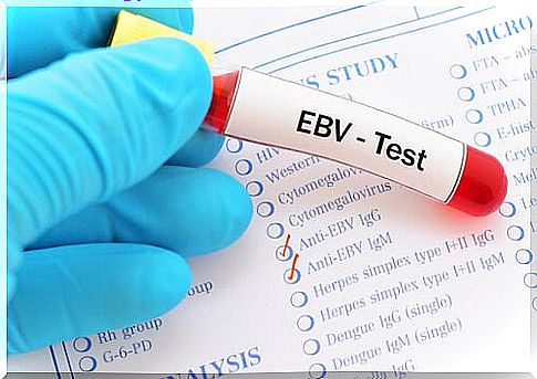 Epstein-Barr virus causes mononucleosis