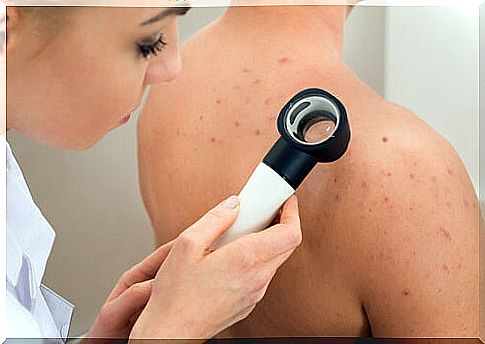 Natural remedies for chickenpox