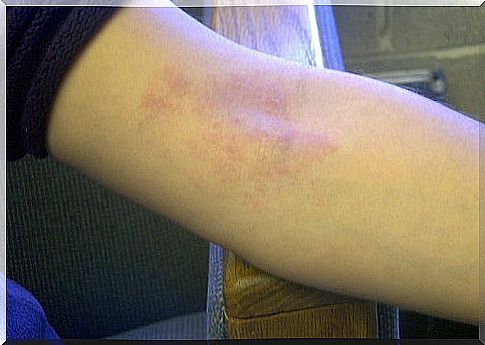 How to prevent dermatitis