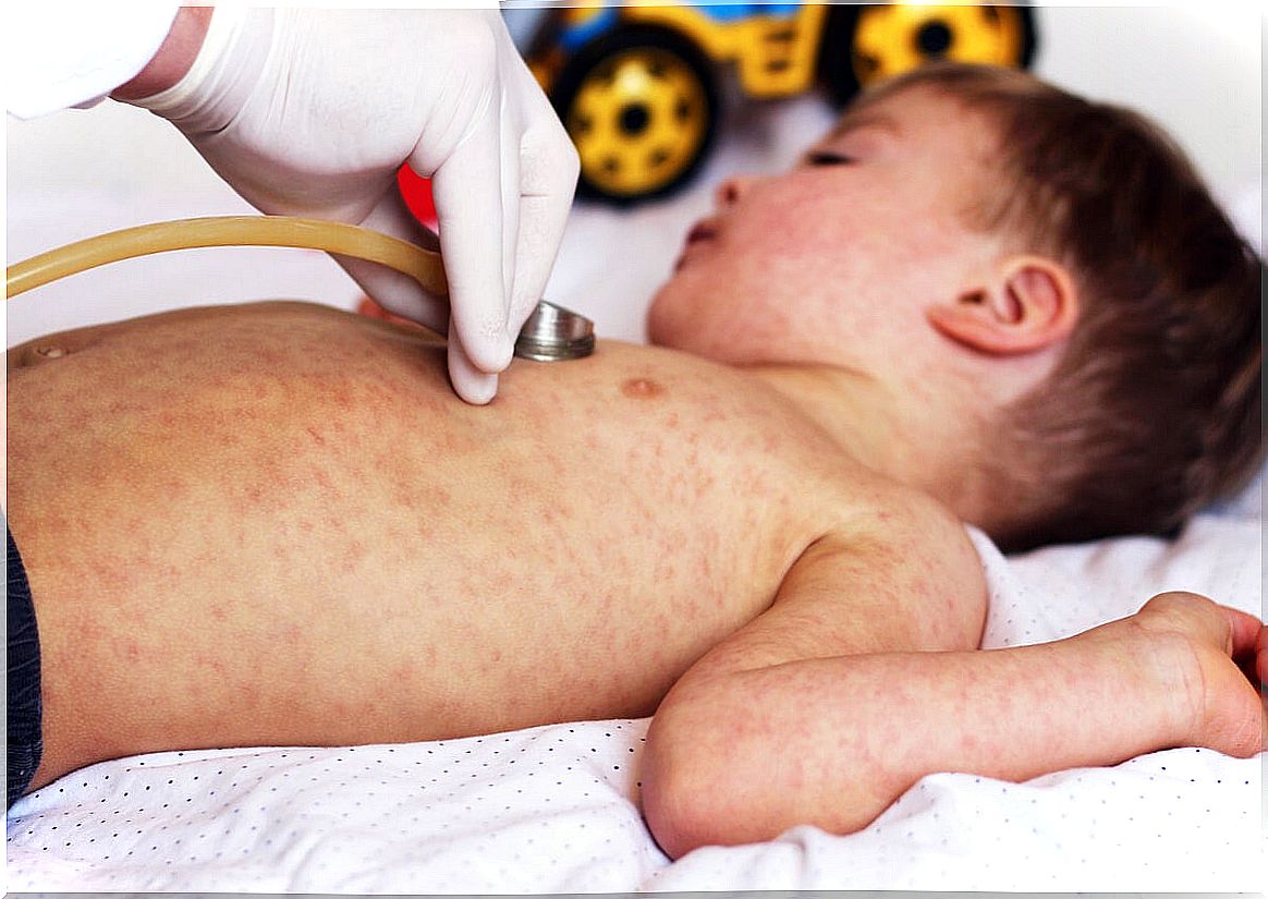 Rubella in children.