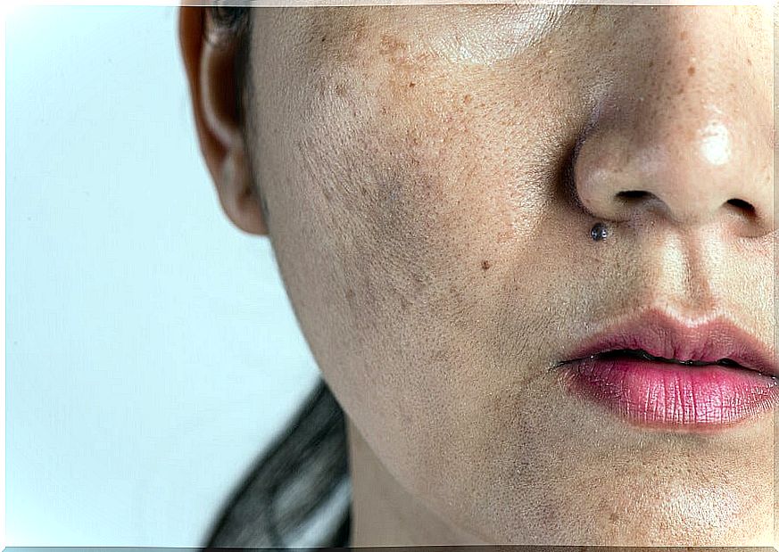 Hyperpigmentation during pregnancy