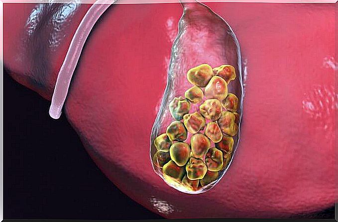 Cholelithiasis or gallstones